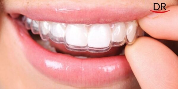 How to clean your spark aligners: tips and guidelines