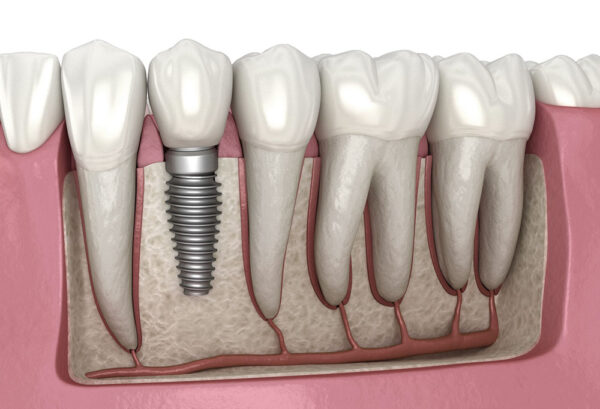 How to clean snap-in dental implants